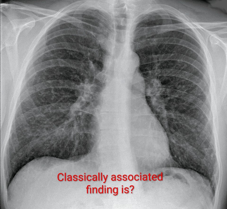 Sarcoidosis Chest X-Ray: Bilateral Hilar Lymphadenopathy & Perilymphatic Pulmonary Nodules | MBBS, NEET PG, INICET, USMLE & PLAB