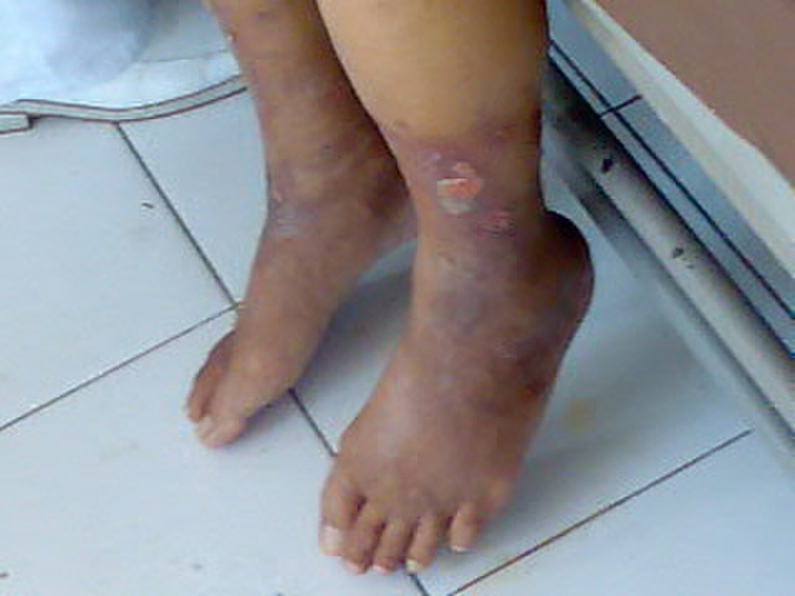 Chronic Venous Insufficiency (CVI): Most Common Cause of Venous Leg Ulcers