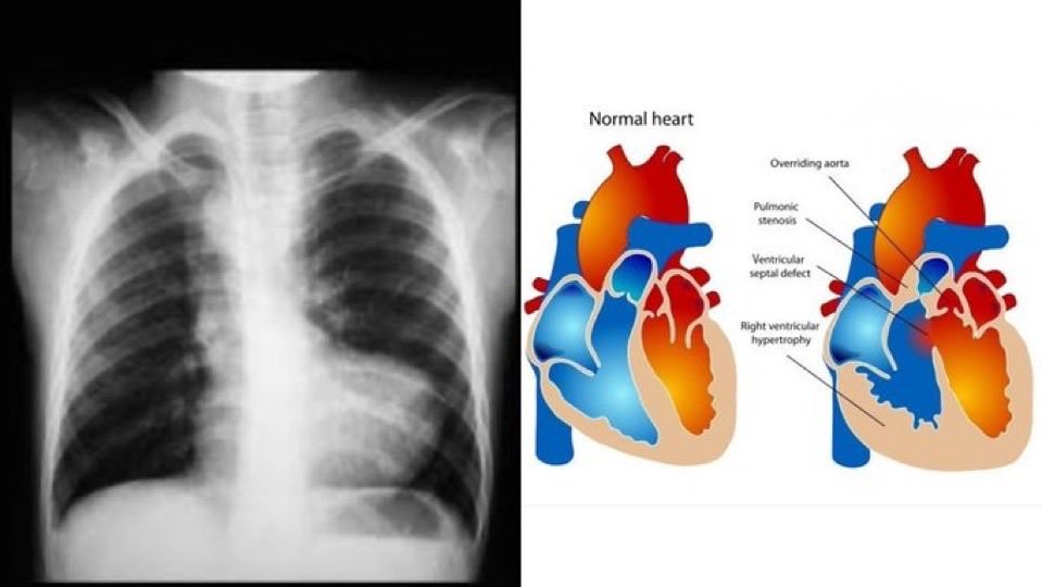 Most Common Cause of Cyanotic Congenital Heart Disease