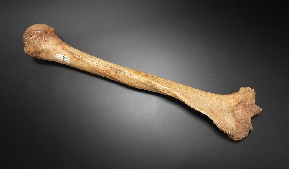 Fracture of the Surgical Neck of the Humerus: Which Nerve Is Injured?