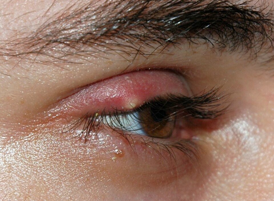 Stye