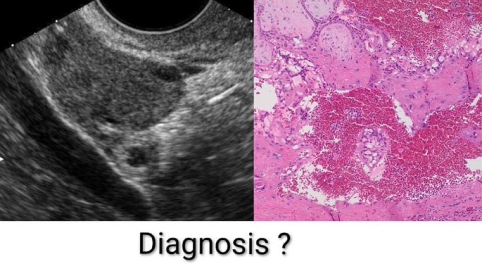 Ectopic Pregnancy: Symptoms, Diagnosis, Ultrasound Findings, β-hCG & Management | MBBS, NEET PG, INICET, FMGE, PLAB & USMLE High-Yield Review