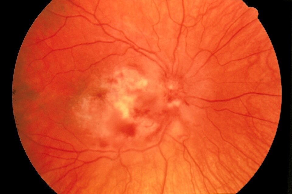 CMV Retinitis in HIV: Symptoms, Fundus Findings, Diagnosis & Treatment | MBBS, NEET PG, INICET, USMLE & PLAB