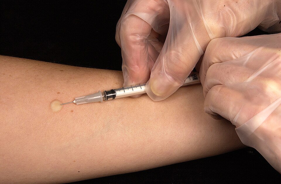 Mantoux (Tuberculin Skin) Test: Procedure, Interpretation, Positive Test Criteria, Clinical Uses & Limitations | MBBS, NEET PG, INICET, FMGE, USMLE & PLAB