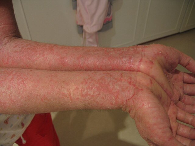 Chronic pruritic, erythematous, scaly lesions with fissuring over both hands.